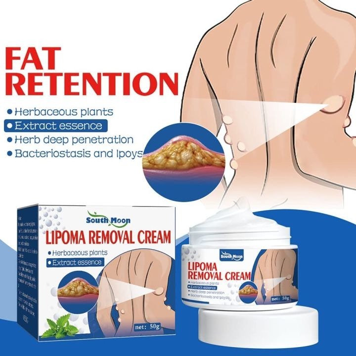 South Moon Lipoma Removal Cream (50g) | Natural Herbal Ointment for Body Lumps & Skin Knot Relief | Professional Skin Smoothing Formula