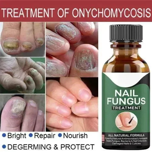 Fast Nail Fungus Treatment Serum – Nail Repair Essence for Finger & Toenail Care (All-Natural Formula)