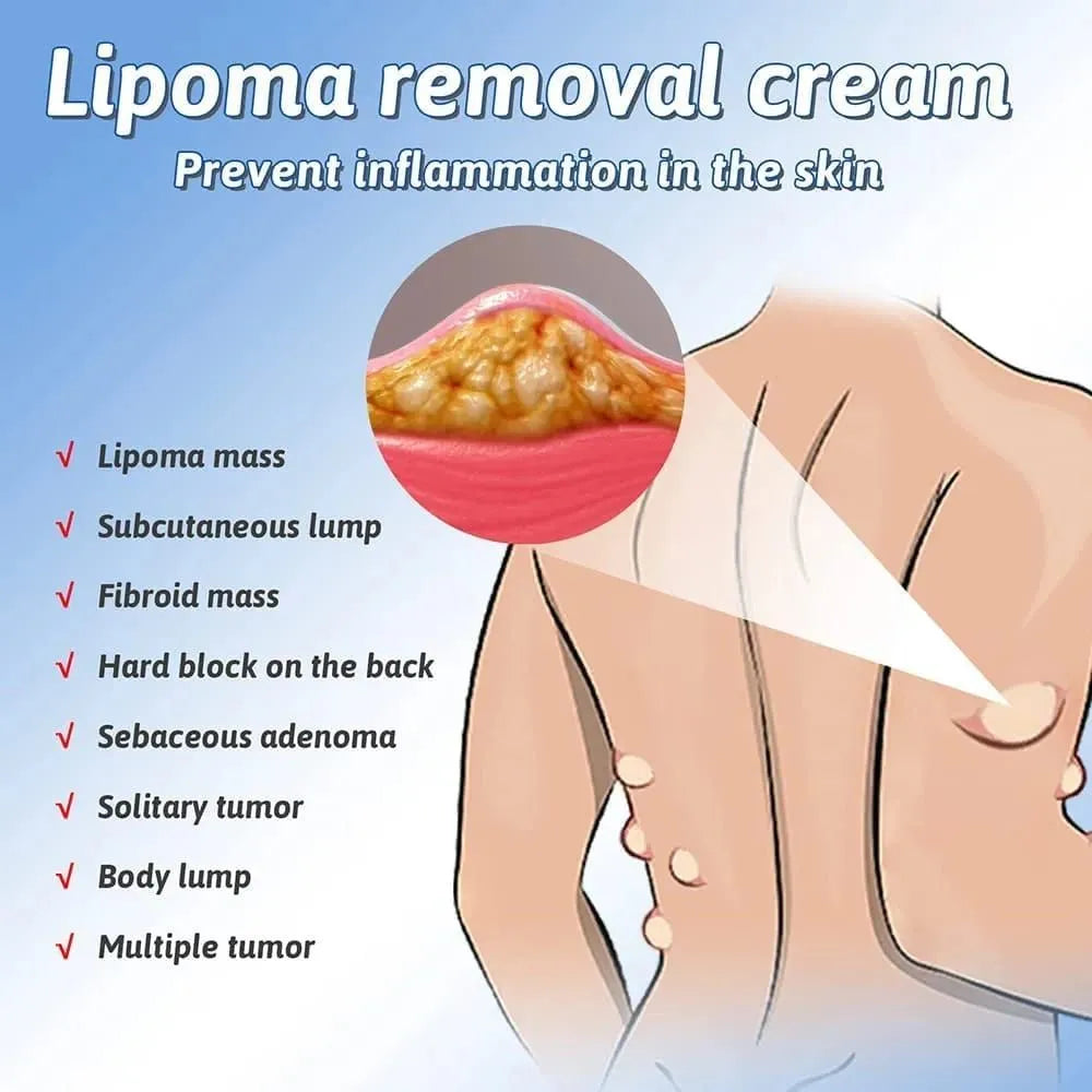 South Moon Lipoma Removal Cream – Herbal Extract Essence Skin Care Treatment (50g)