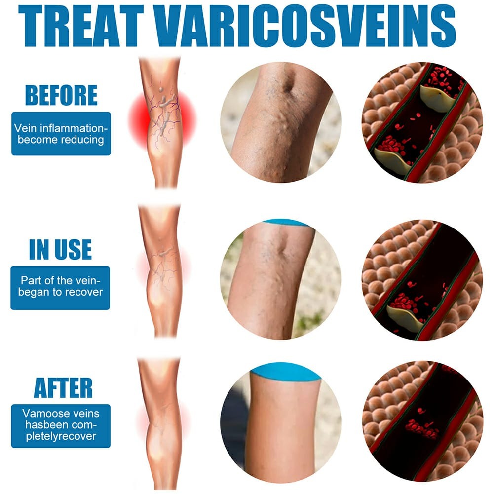 South Moon Varicose Veins Treatment Spray – 35ml Advanced Formula for Spider Veins, Leg Pain & Swelling Relief | Natural Herbal Spray for Better Circulation