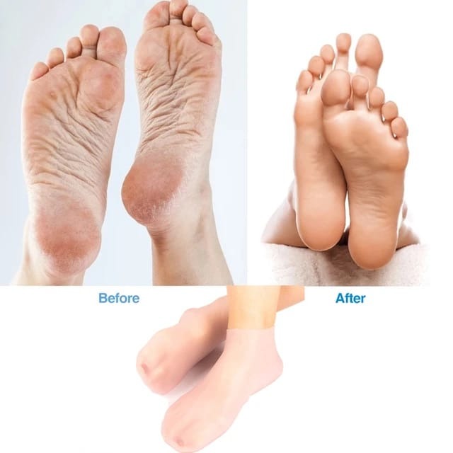 01 Pair - Silicone Foot Care Socks Anti Cracking Moisturizing Gel Socks Cracked Dead Skin Remove Protector - Silicone Socks And Gloves For Moisturizing Hands And Feet