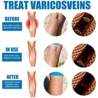 Varicose Veins Treatment Spray – Advanced Formula for Spider Veins, Leg Pain & Swelling Relief ~ 30ml