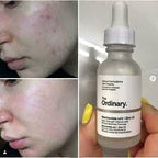 The Ordinary Niacinamide 10% + Zinc 1 % - 30ml |Oil Control, Pore Minimizing &amp; Blemish Solution Serum|