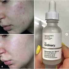 The Ordinary Niacinamide 10% + Zinc 1 % - 30ml |Oil Control, Pore Minimizing &amp; Blemish Solution Serum|